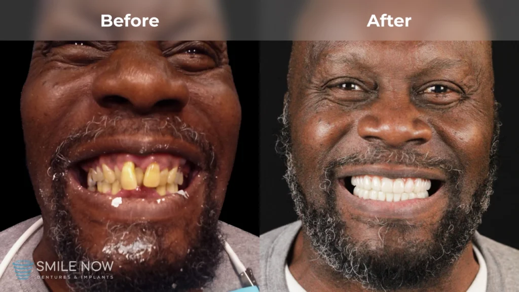 Before and after dental implants in Tacoma, WA at Smile Now Tacoma Dentures and Implants