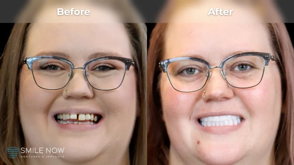 Before and after dental implants in Tacoma, WA at Smile Now Tacoma Dentures and Implants