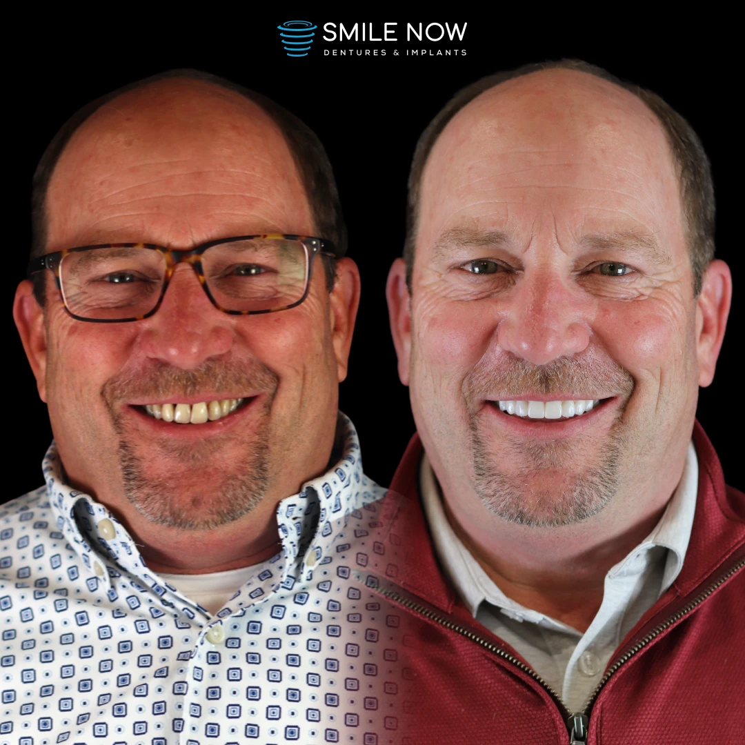 Before and after transformation of dental implants with bone loss
